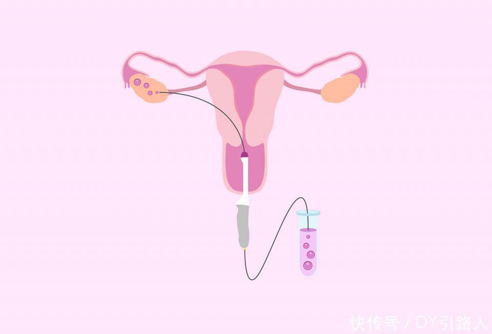 试管婴儿取卵过程