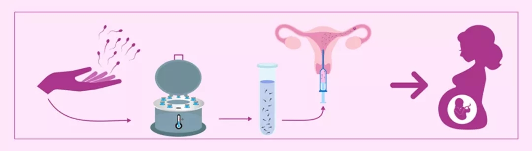宫腔内人工授精 (IUI) 的好处和局限性