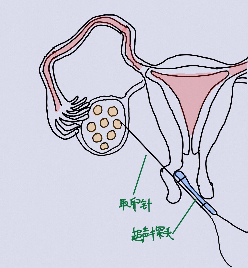 取卵手术过程