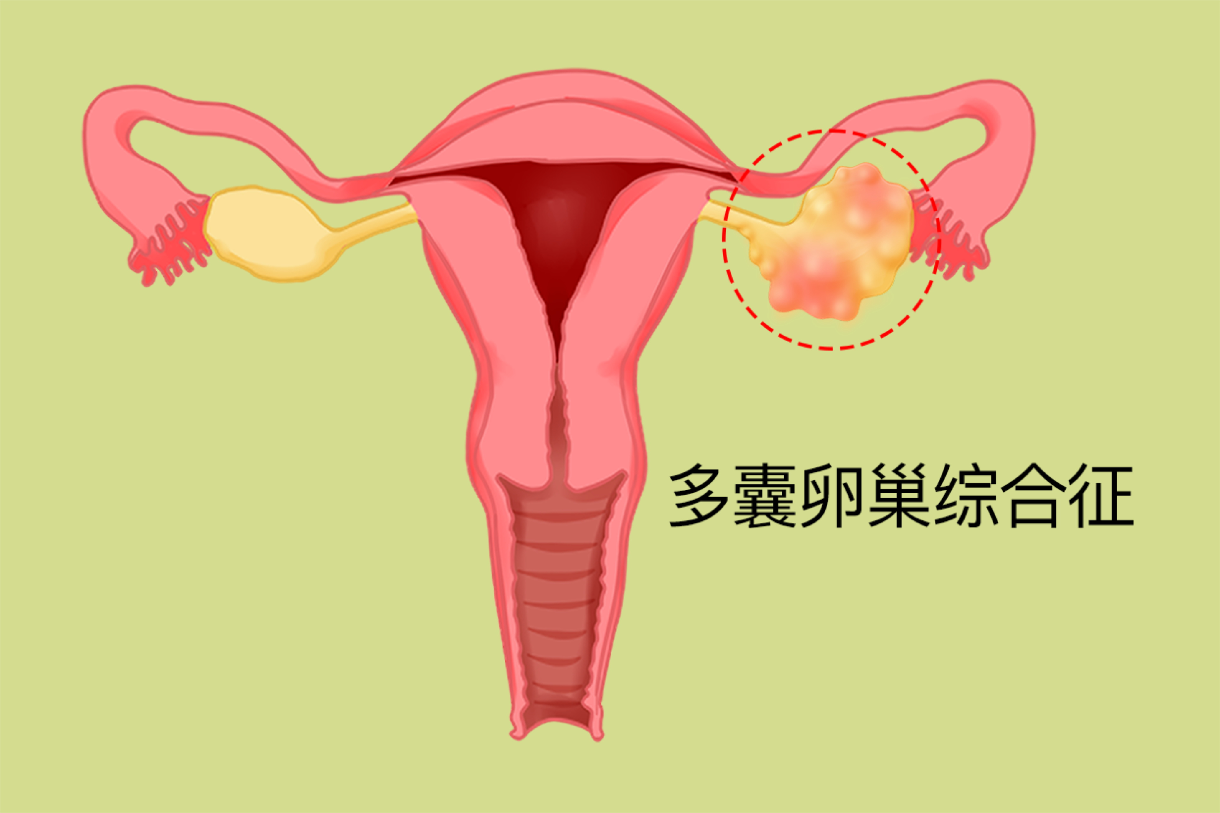 多囊卵巢综合征(PCOS)做试管成功率高吗