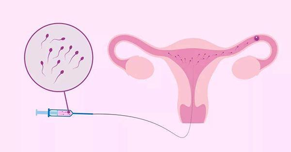 人工受孕跟试管的差别