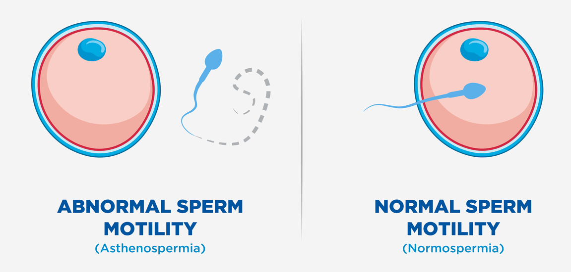 精子质量差 试管婴儿