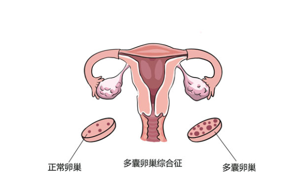 多囊IVF