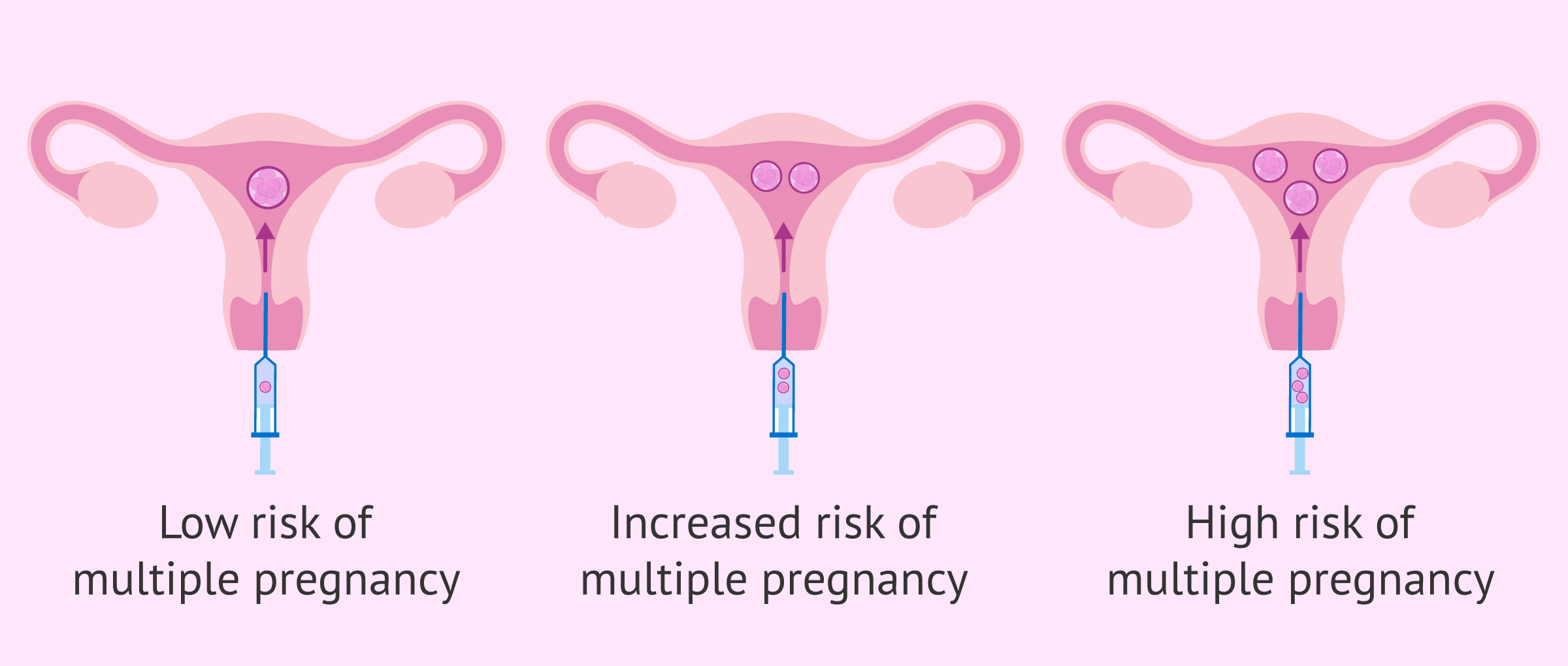 试管移植 移植双胎
