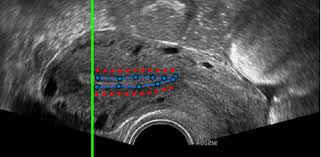 试管移植前检查