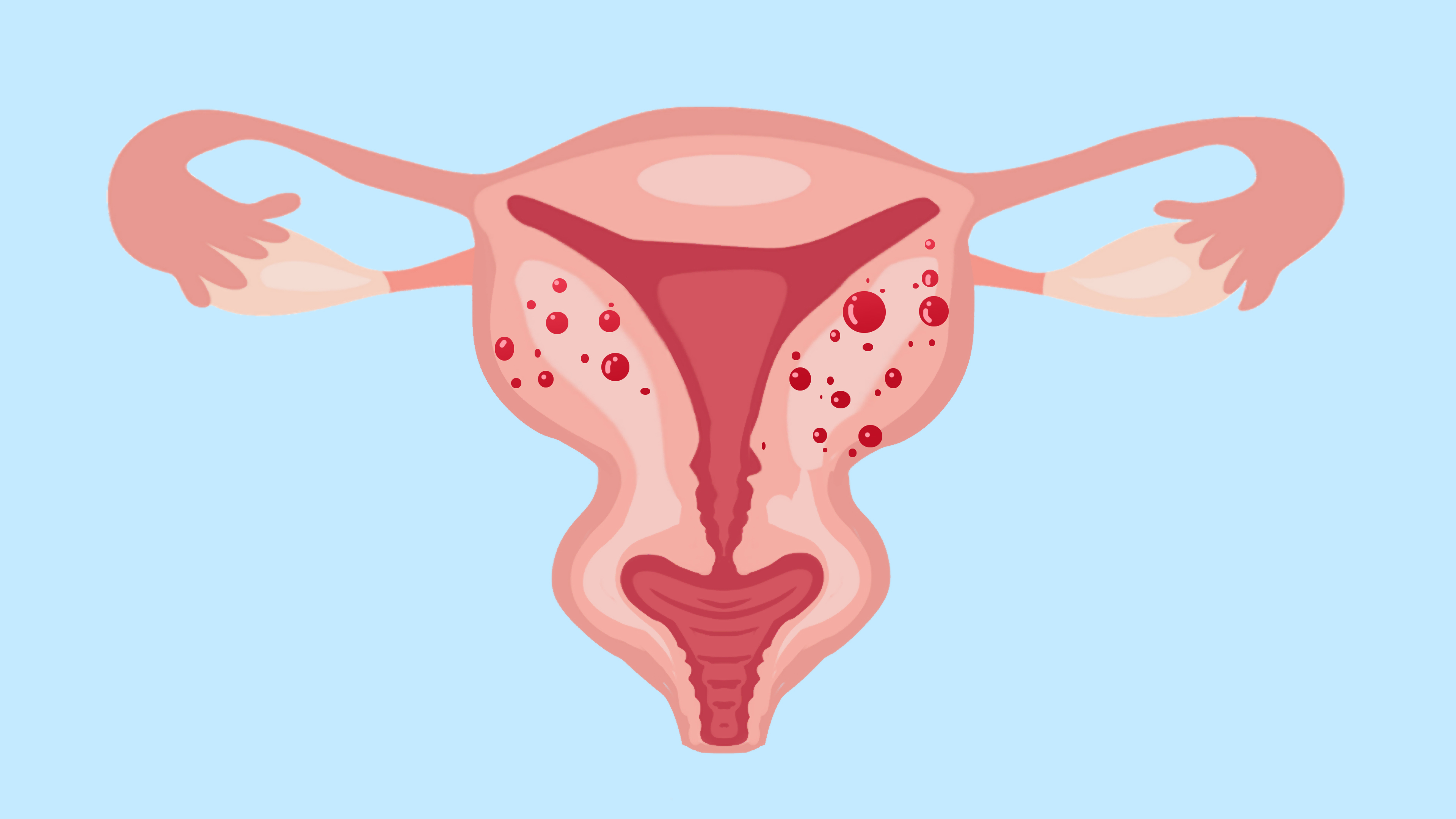 子宫内膜异位症