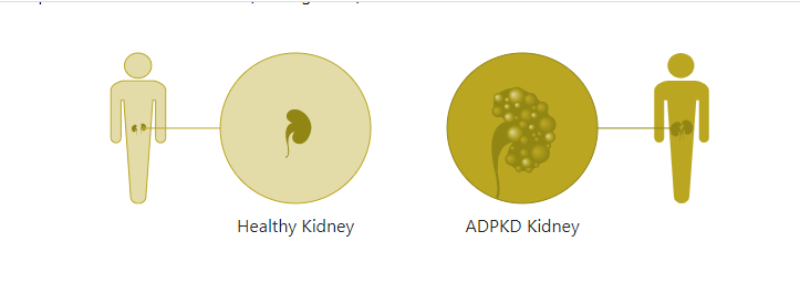 三代试管 多囊肾