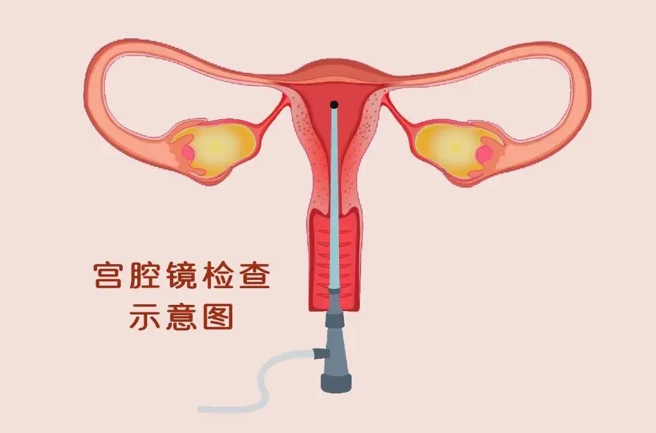 试管婴儿前一定要做宫腔镜检查吗?