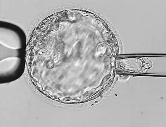 第三代试管婴儿