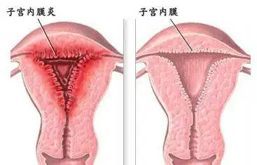 慢性子宫内膜炎